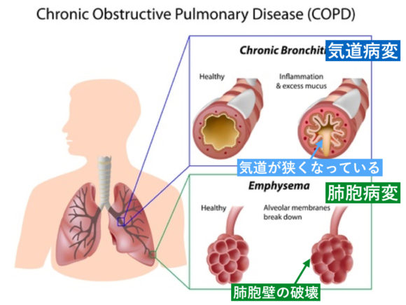 COPDの病態